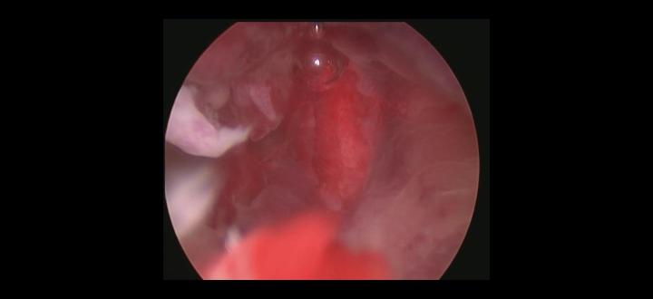 Polip endometrial aspect histeroscopic