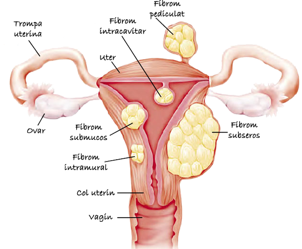 fibrom-uterin